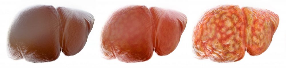 Realistic stages of a fatty liver -- 3D Rendering